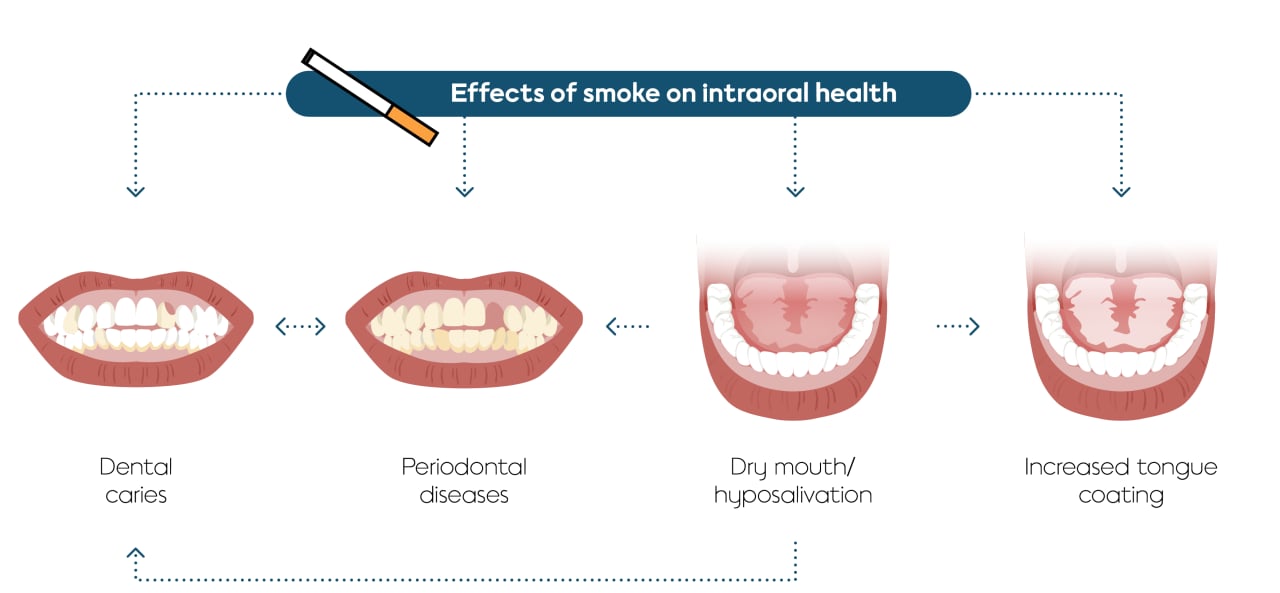 Illustration showing mechanisms by which smoking contributes to intraoral halitosis.